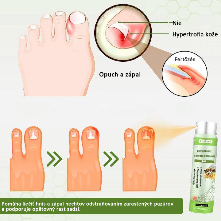 🔥Najobľúbenejšie丨50 % zľava na obmedzený čas | Foulme® NailRescue sprej s včelím jedom🐝