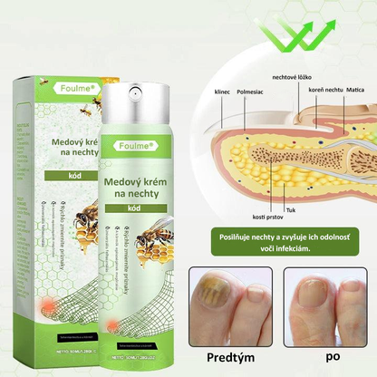 🔥Najobľúbenejšie丨50 % zľava na obmedzený čas | Foulme® NailRescue sprej s včelím jedom🐝